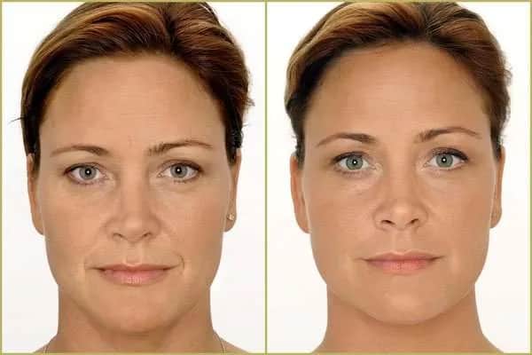 Kwas hialuronowy ile się trzyma - jak długo utrzymują się efekty?