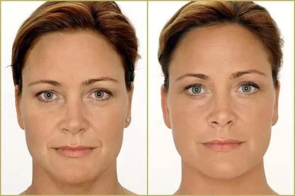 Kwas hialuronowy ile się trzyma - jak długo utrzymują się efekty?