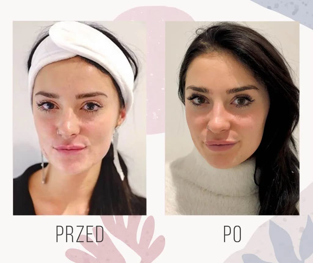 Kwas hialuronowy w ustach - jak długo się utrzymuje efekt?