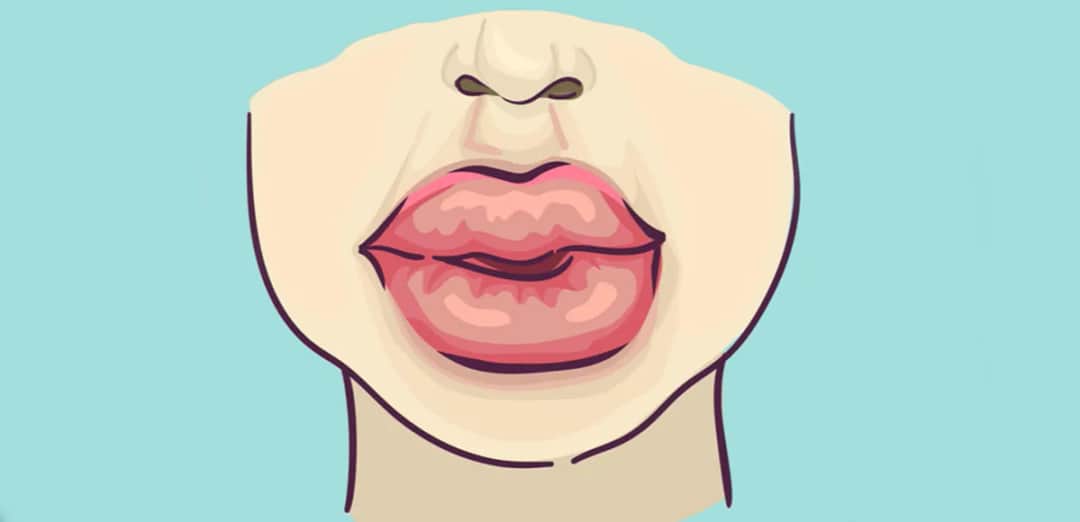 Jak rozpuścić kwas hialuronowy i uniknąć niepożądanych efektów